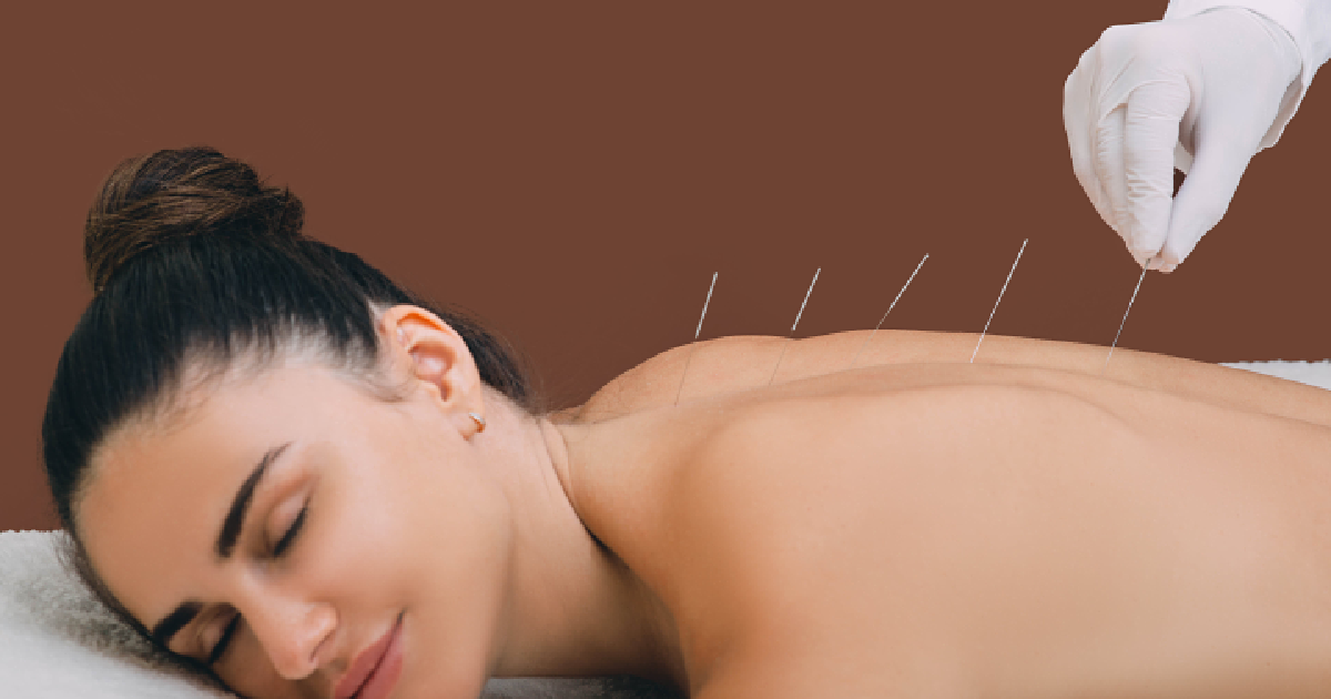 Woman lying face down with eyes closed, receiving acupuncture treatment on her back from a professional wearing white gloves in Avon, CT