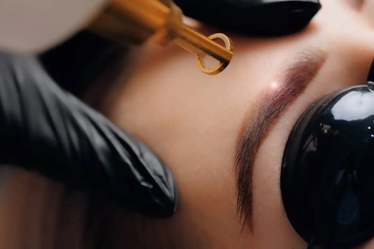 Laser Tattoo Removal